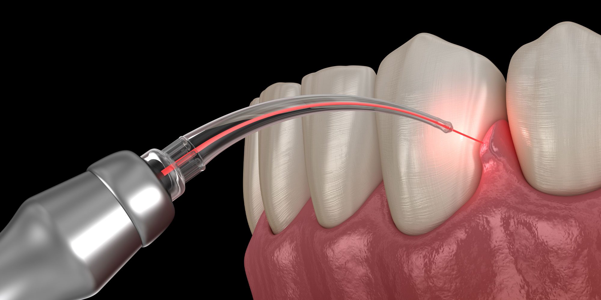 Close-up of dental laser equipment used in dentistry