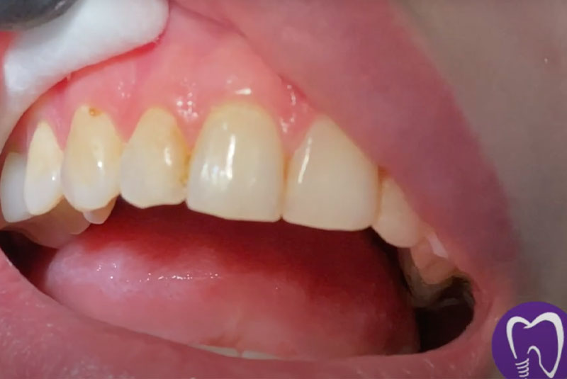 laser dentistry thuhmbnail