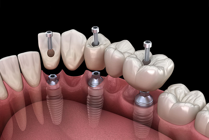 close up of 3d illustration of full mouth dental implant