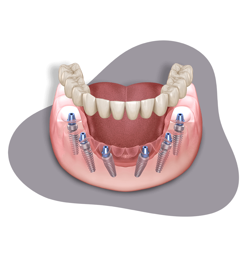 close up of full arch dental implant