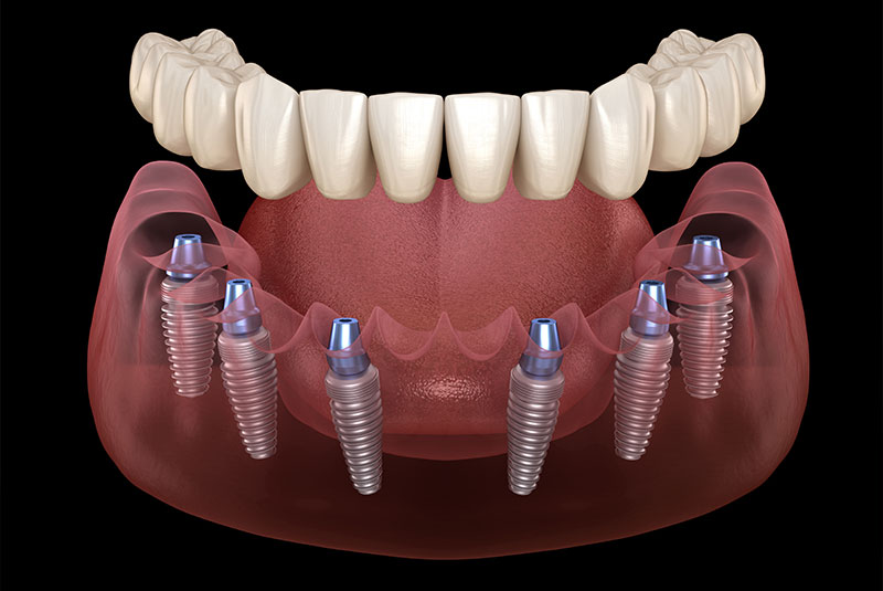 close up of 3d illustration of full arch dental implant
