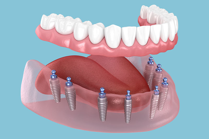 all on x dental implant 3d illustration