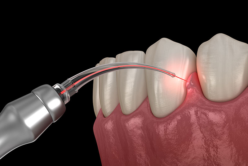 Gum correction surgery with laser. Medically accurate tooth 3D illustration