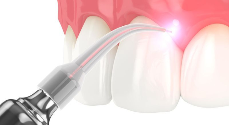 How Laser Dentistry in Kearny Treats Gum Disease Without Scalpels or Stitches